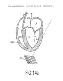 Three Dimensional Ultrasonic Scanning With Live Subvolumes diagram and image