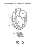 Three Dimensional Ultrasonic Scanning With Live Subvolumes diagram and image