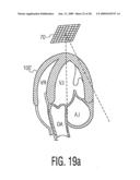 Three Dimensional Ultrasonic Scanning With Live Subvolumes diagram and image