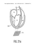 Three Dimensional Ultrasonic Scanning With Live Subvolumes diagram and image