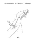 Subcutaneous Implant System diagram and image