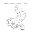 Devices and methods for treating morbid obesity diagram and image