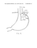 Devices and methods for treating morbid obesity diagram and image