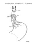 Devices and methods for treating morbid obesity diagram and image