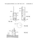 Devices and methods for treating morbid obesity diagram and image