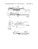 Devices and methods for treating morbid obesity diagram and image