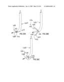 Devices and methods for treating morbid obesity diagram and image