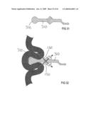 Devices and methods for treating morbid obesity diagram and image