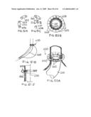 Devices and methods for treating morbid obesity diagram and image