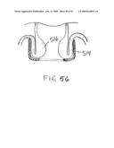 Devices and methods for treating morbid obesity diagram and image