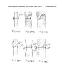 Devices and methods for treating morbid obesity diagram and image