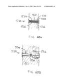 Devices and methods for treating morbid obesity diagram and image