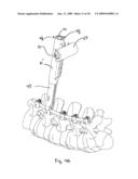 SYSTEM AND METHOD OF MANIPULATING SPINAL CONSTRUCTS diagram and image