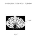 STRUCTURALLY REINFORCED SPINAL NUCLEUS IMPLANTS diagram and image