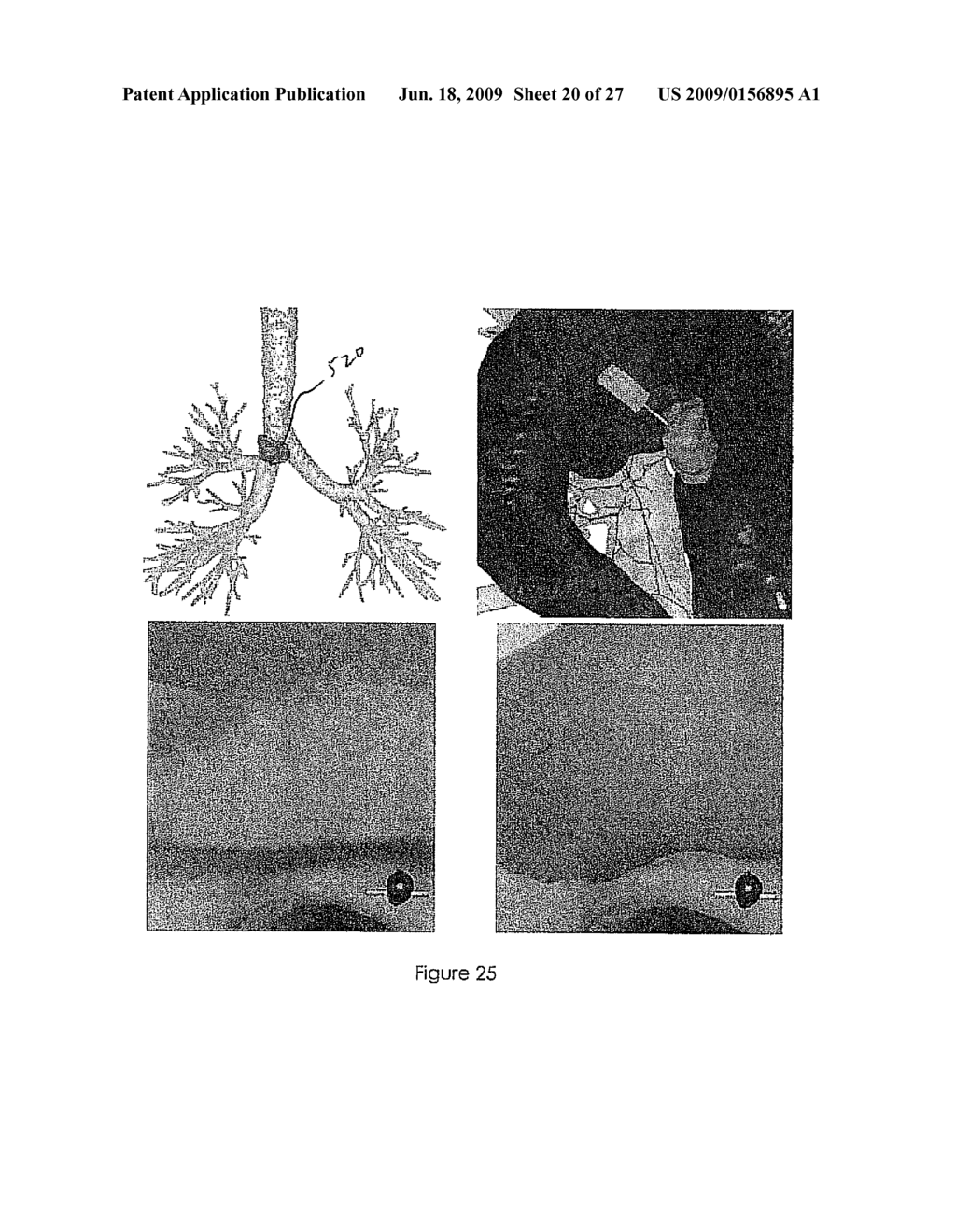 PRECISE ENDOSCOPIC PLANNING AND VISUALIZATION - diagram, schematic, and image 21