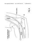 ARTICULATING HOOK ELEVATOR AND ARTHROSCOPIC METHOD FOR USING SAME diagram and image