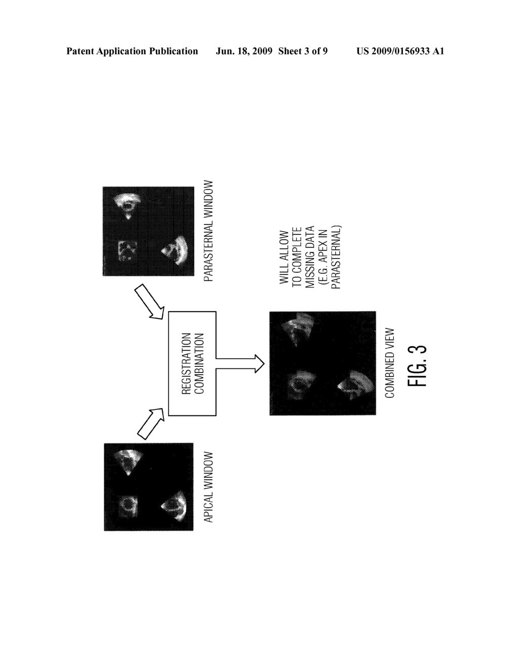 ULTRASOUND SYSTEM FOR RELIABLE 3D ASSESSMENT OF RIGHT VENTRICLE OF THE HEART AND METHOD OF DOING THE SAME - diagram, schematic, and image 04