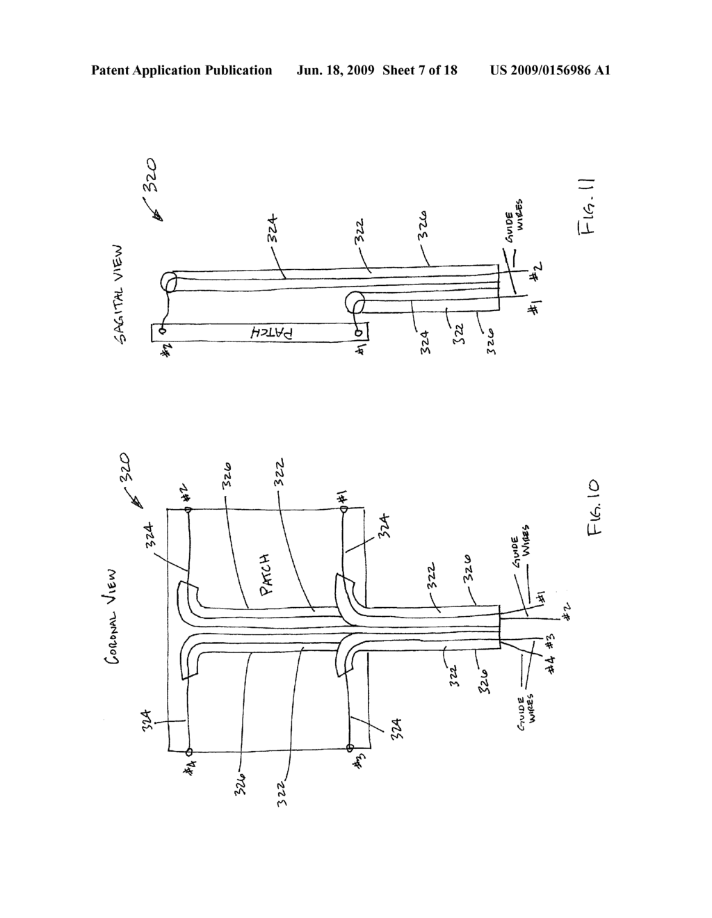 ROTATOR CUFF PATCH DELIVERY DEVICE - diagram, schematic, and image 08