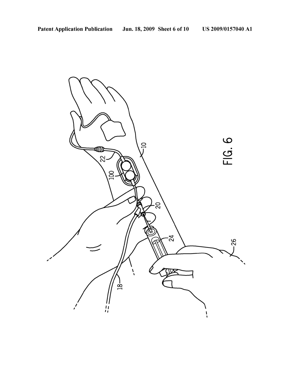 DIFFERENTIAL PRESSURE BASED FLOW SENSOR ASSEMBLY FOR MEDICATION DELIVERY MONITORING AND METHOD OF USING THE SAME - diagram, schematic, and image 07