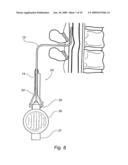 Epidural administration systems diagram and image