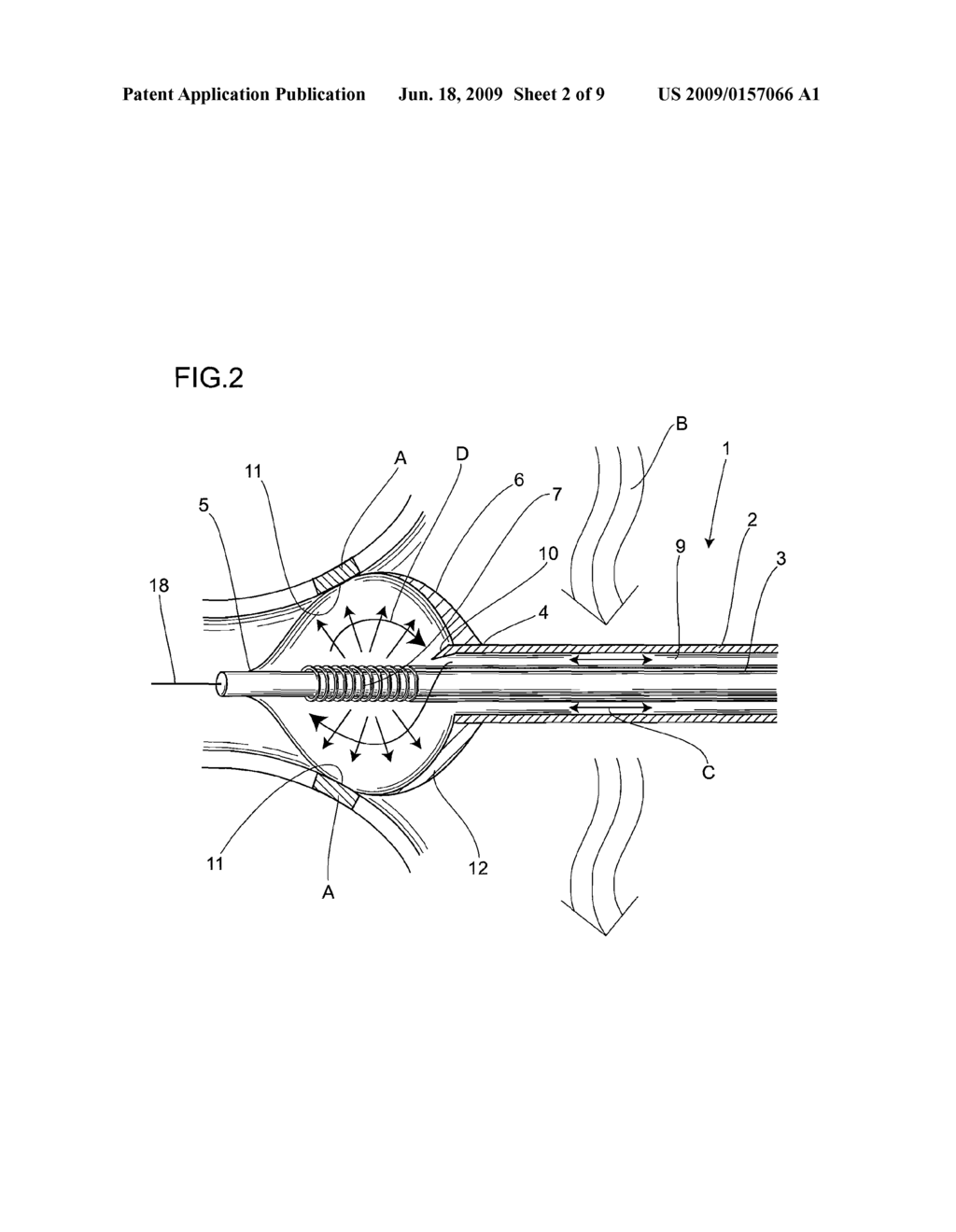 BALLOON CATHETER SYSTEM - diagram, schematic, and image 03