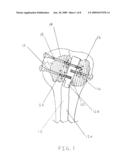 Apparatus and Methods of Repairing Bone Defects diagram and image