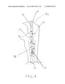 Apparatus and Methods of Repairing Bone Defects diagram and image