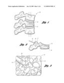 DEVICE AND METHOD FOR INTRODUCING A BONE CEMENT MIXTURE INTO A DAMAGED BONE diagram and image