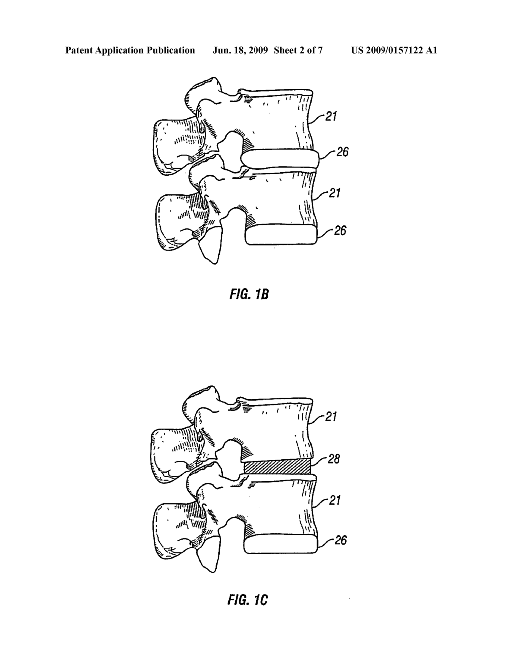 BONE COMPRESSION DEVICE - diagram, schematic, and image 03