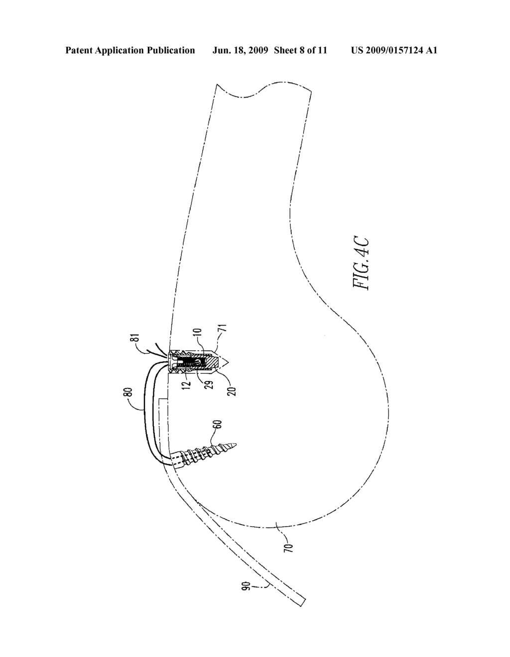 Anchoring System - diagram, schematic, and image 09