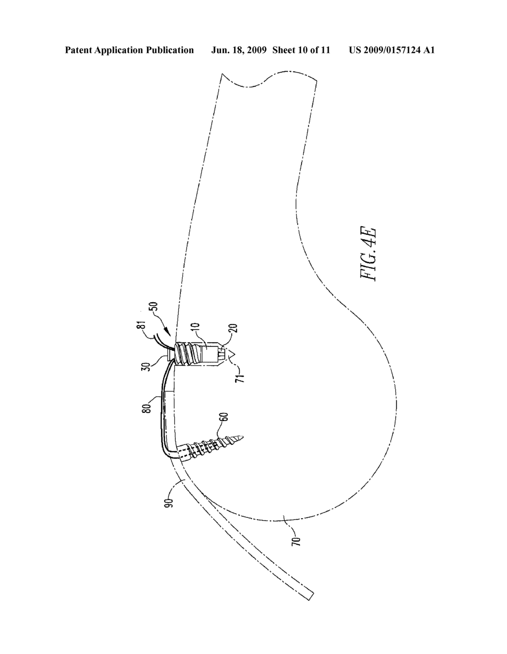 Anchoring System - diagram, schematic, and image 11