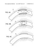 Degradable Endoprosthesis diagram and image