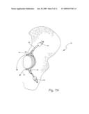 Biologic Artificial Bone diagram and image