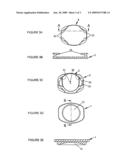 Intervertebral Disc Prosthesis diagram and image