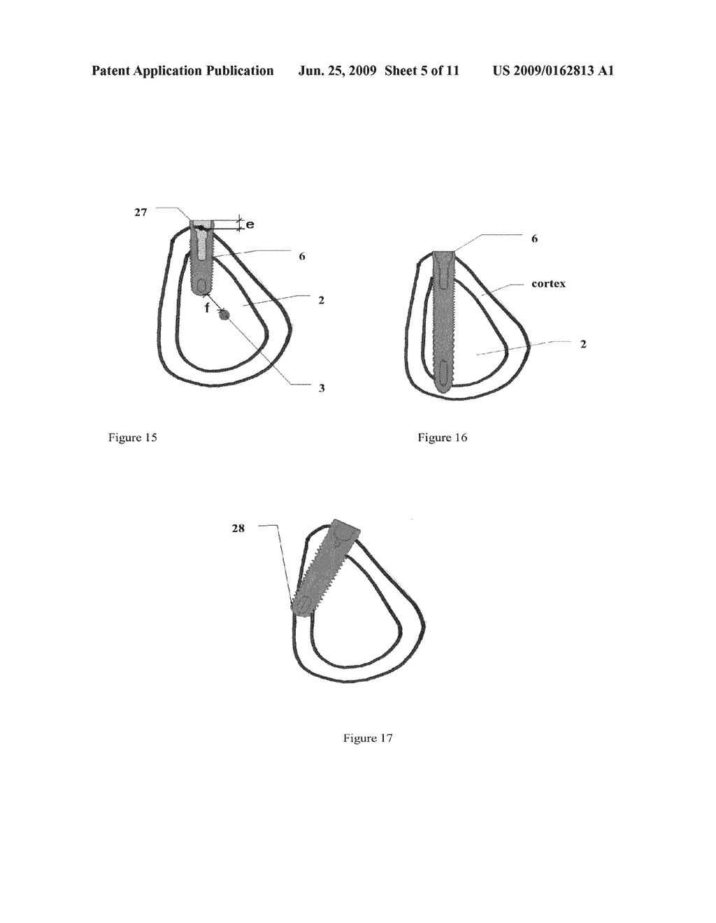 Method for (semi-) automatic dental implant planning - diagram, schematic, and image 06