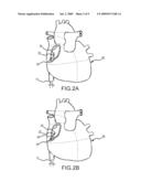 DEFLECTABLE CATHETER WITH DISTAL DEFLECTABLE SEGMENT diagram and image