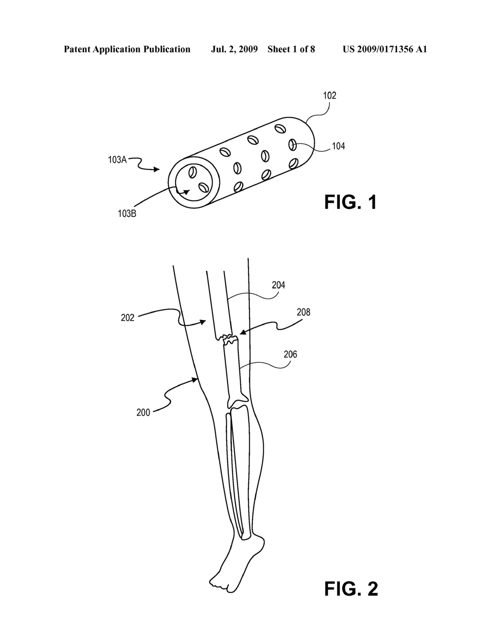 Bone Repositioning Apparatus and System - diagram, schematic, and image 02