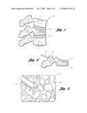 DEVICE AND METHOD FOR MIXING AND DISPENSING A BONE CEMENT MIXTURE diagram and image