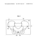 Navigation System for Hip Replacement Surgery Having Reference Mechanism and Method Using the Same diagram and image