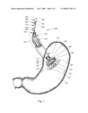 DELIVERY SYSTEM AND METHOD OF DELIVERY FOR TREATING OBESITY diagram and image