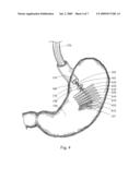 DELIVERY SYSTEM AND METHOD OF DELIVERY FOR TREATING OBESITY diagram and image