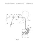 DELIVERY SYSTEM AND METHOD OF DELIVERY FOR TREATING OBESITY diagram and image