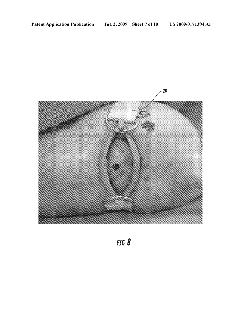 EMERGENCY SNAKE BITE TREATMENT DEVICES, MEDICAL KITS AND RELATED METHODS - diagram, schematic, and image 08