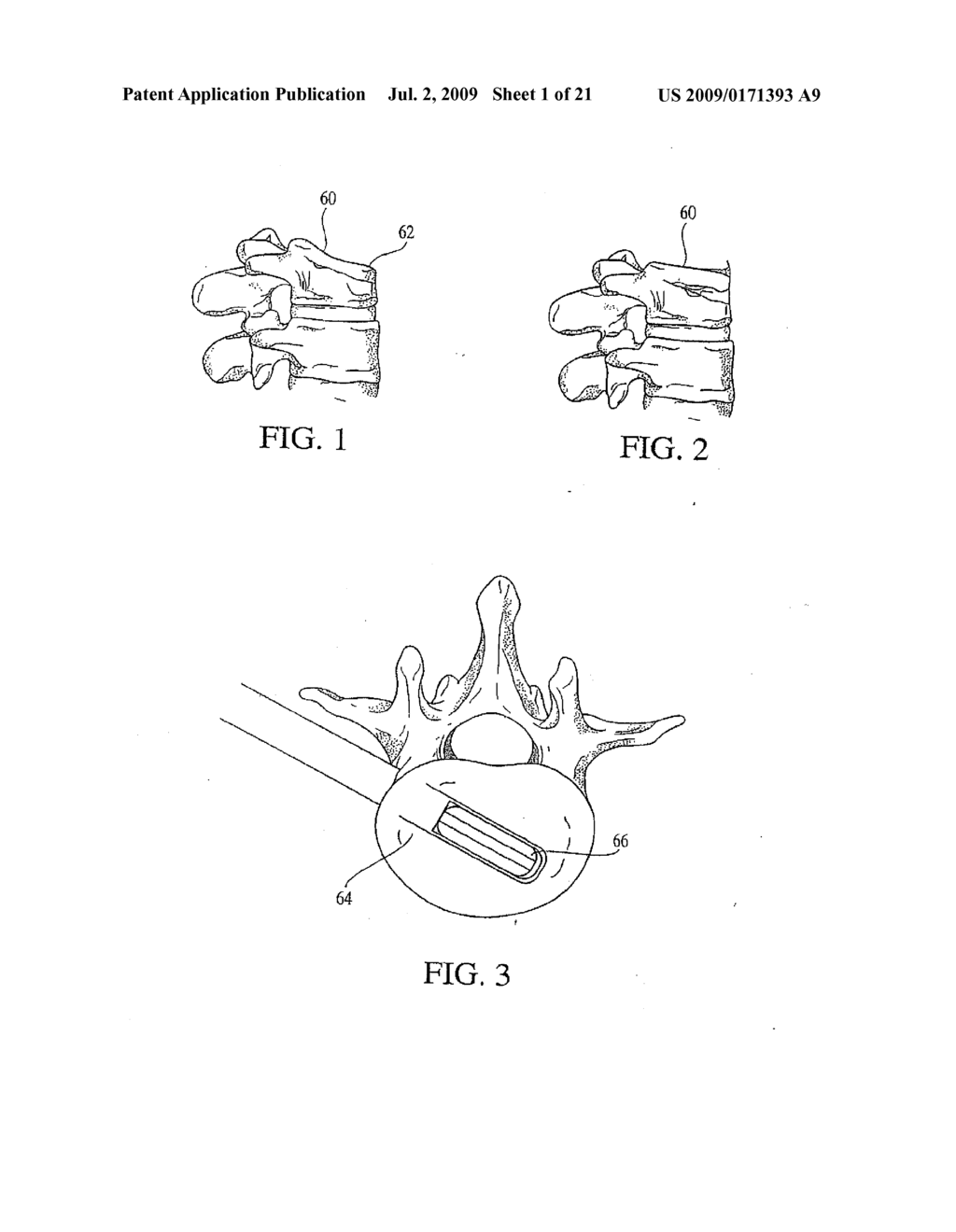 Tissue Distraction Device - diagram, schematic, and image 02