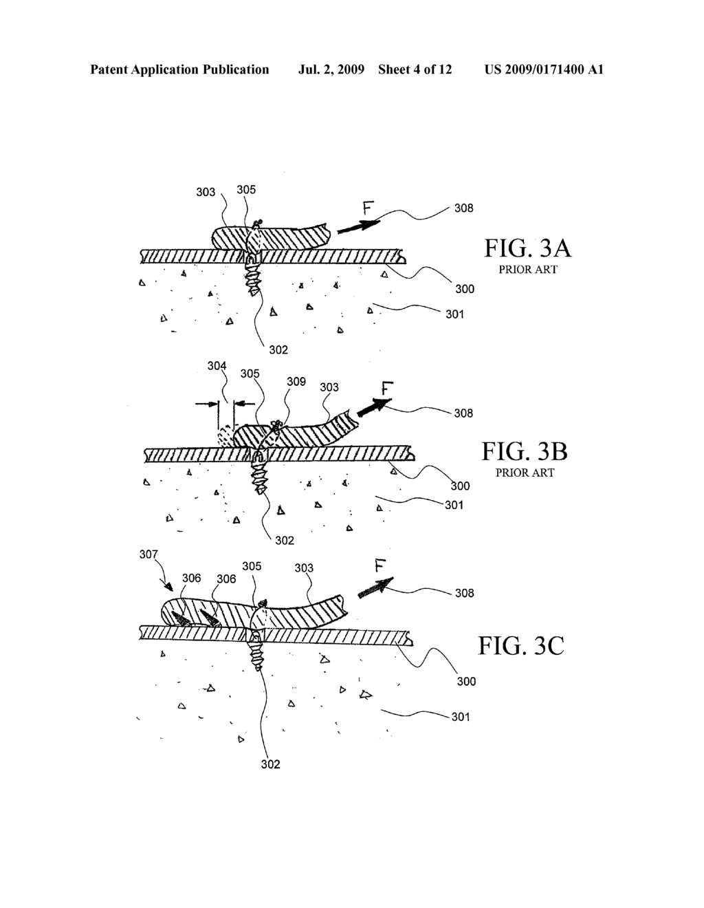 APPARATUS FOR DISCRETE TISSUE ANCHORING FOR SOFT TISSUE REPAIR AND METHOD OF USE - diagram, schematic, and image 05