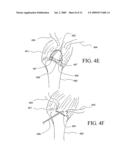 APPARATUS FOR DISCRETE TISSUE ANCHORING FOR SOFT TISSUE REPAIR AND METHOD OF USE diagram and image