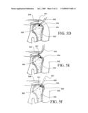 APPARATUS FOR DISCRETE TISSUE ANCHORING FOR SOFT TISSUE REPAIR AND METHOD OF USE diagram and image