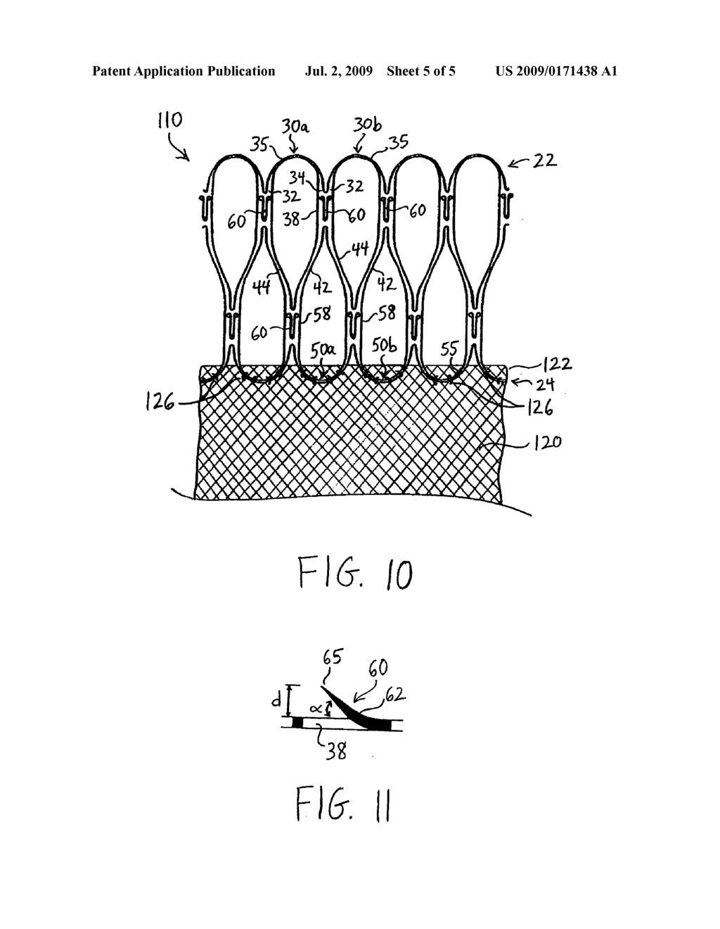 STENT HAVING LESS INVASIVE ENDS - diagram, schematic, and image 06