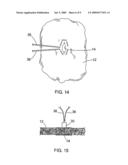 MEDICAL SYSTEMS, DEVICES AND METHODS FOR ENDOSCOPICALLY SUTURING PERFORATIONS diagram and image