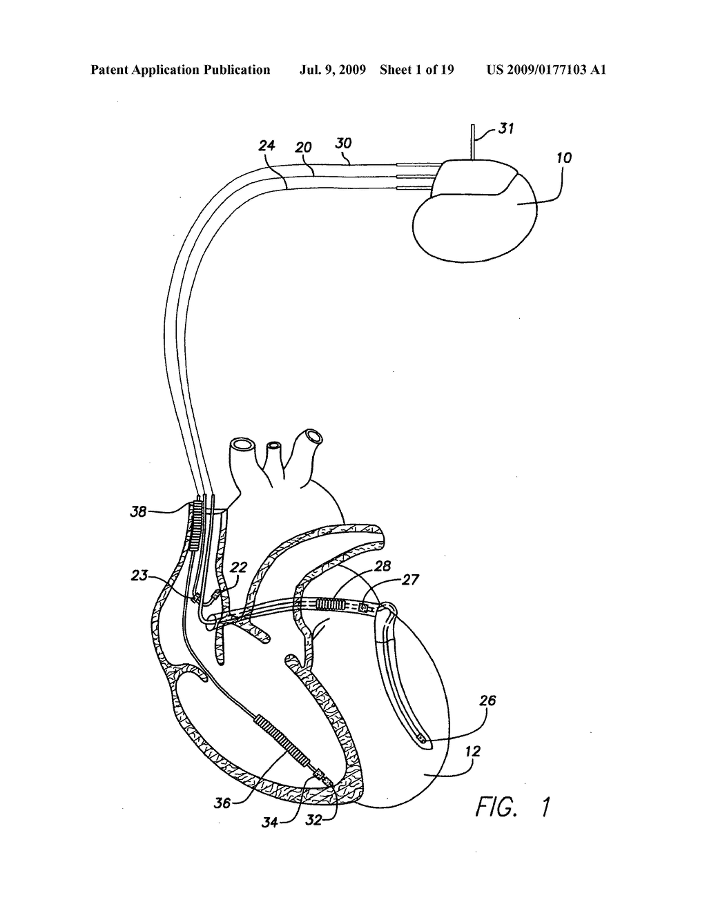 System and Method for Distinguishing Between Hypoglycemia and Hyperglycemia Using an Implantable Medical Device - diagram, schematic, and image 02